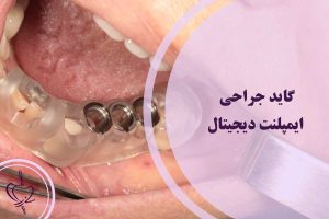 گاید جراحی ایمپلنت دیجیتال