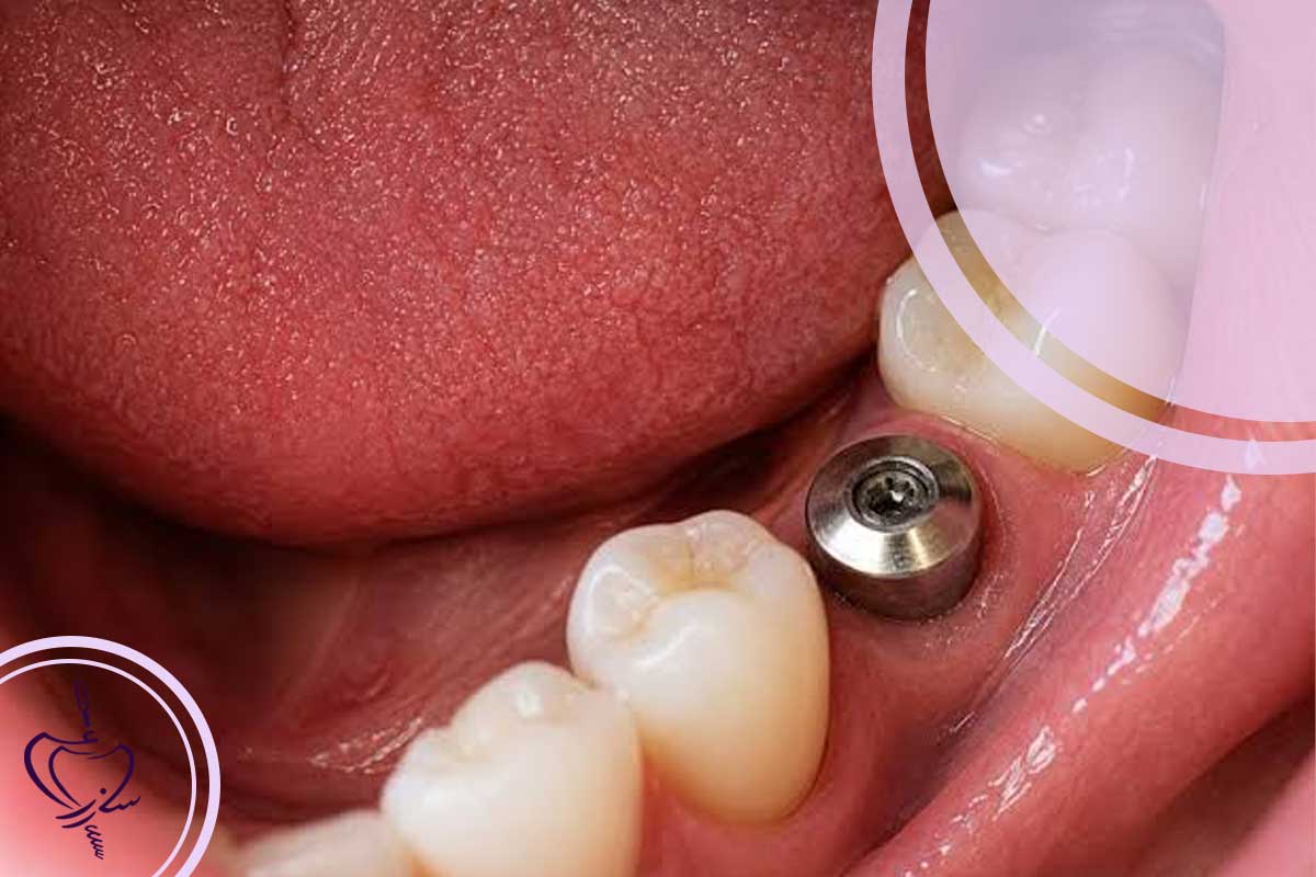 شرایط اولیه دهان بر سلامت ایمپلنت