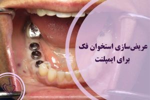 عریضسازی استخوان فک برای ایمپلنت