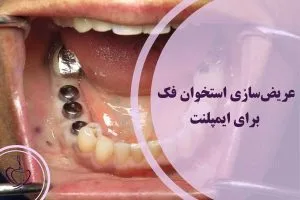 عریضسازی استخوان فک برای ایمپلنت