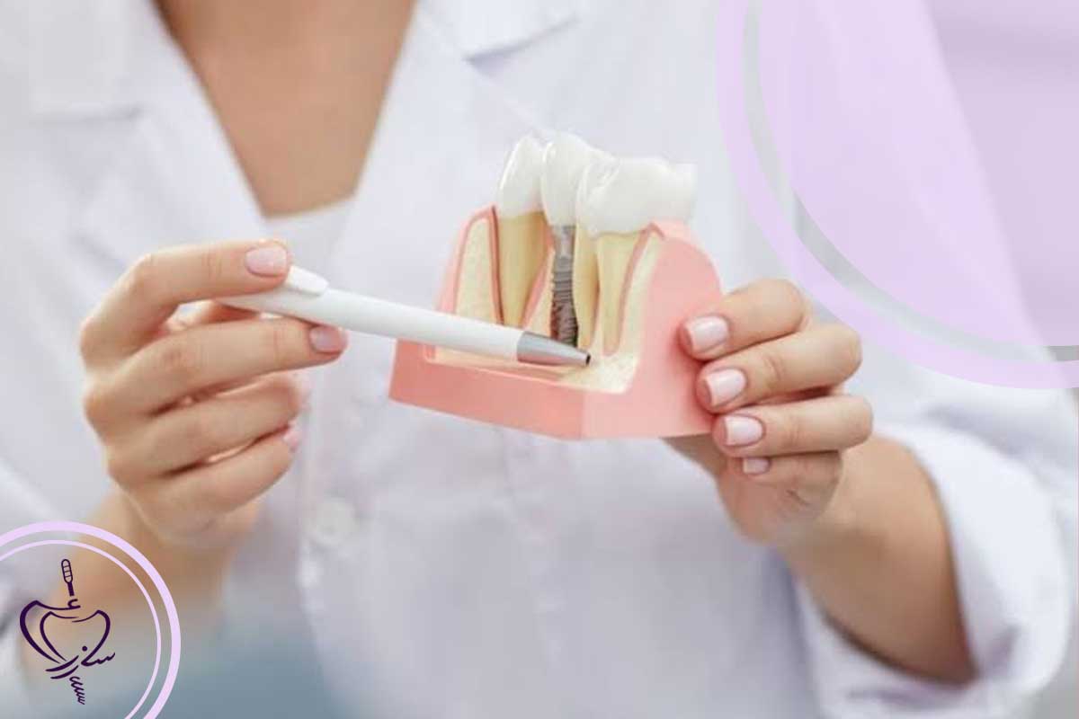 مراقبتهای بعد از کاشت ایمپلنت