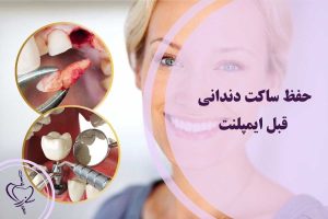 حفظ ساکت دندانی قبل ایمپلنت