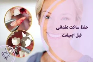 حفظ ساکت دندانی قبل ایمپلنت