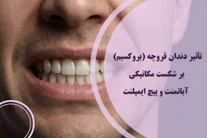تأثیر دندان قروچه بر شکست مکانیکی آباتمنت و پیچ ایمپلنت