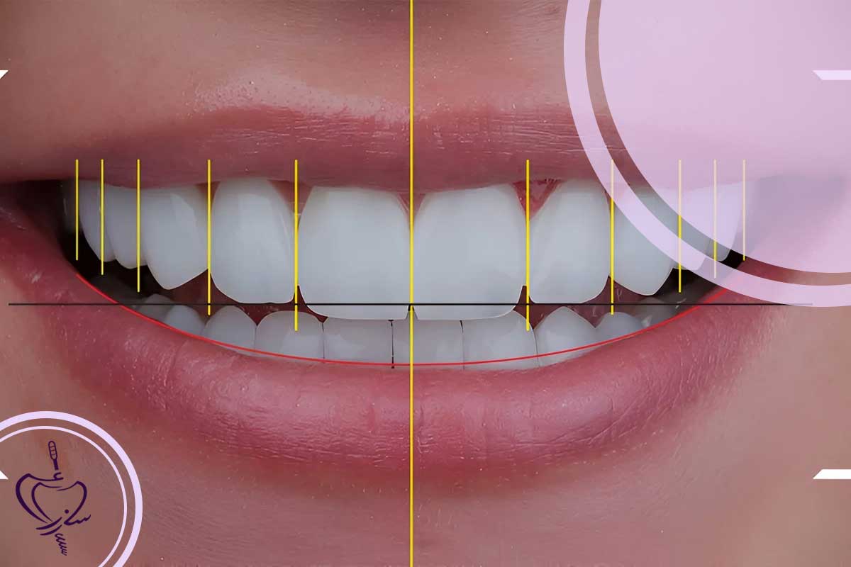 هزینه اصلاح شیب معکوس لبخند